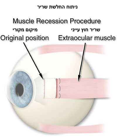 ניתוח החלשת שריר: מזיזים את מיקום השריר לצורך החלשתו ותיקון הפזילה